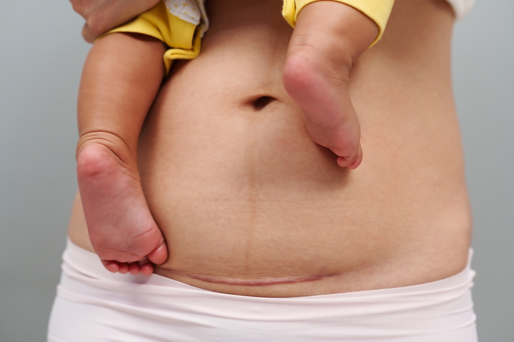 c section scar.